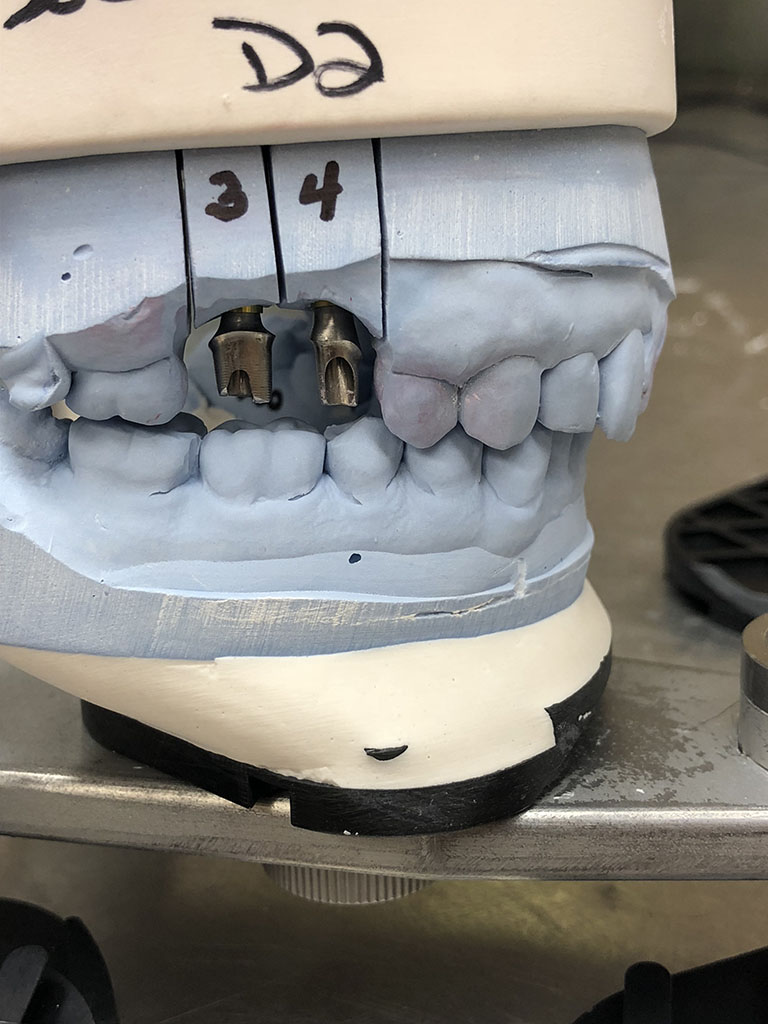 Distorted Impression - Brandon Dental Lab