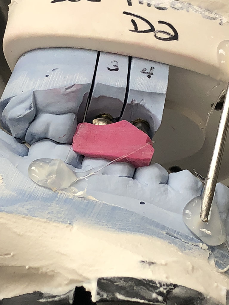 Distorted Impression - Brandon Dental Lab