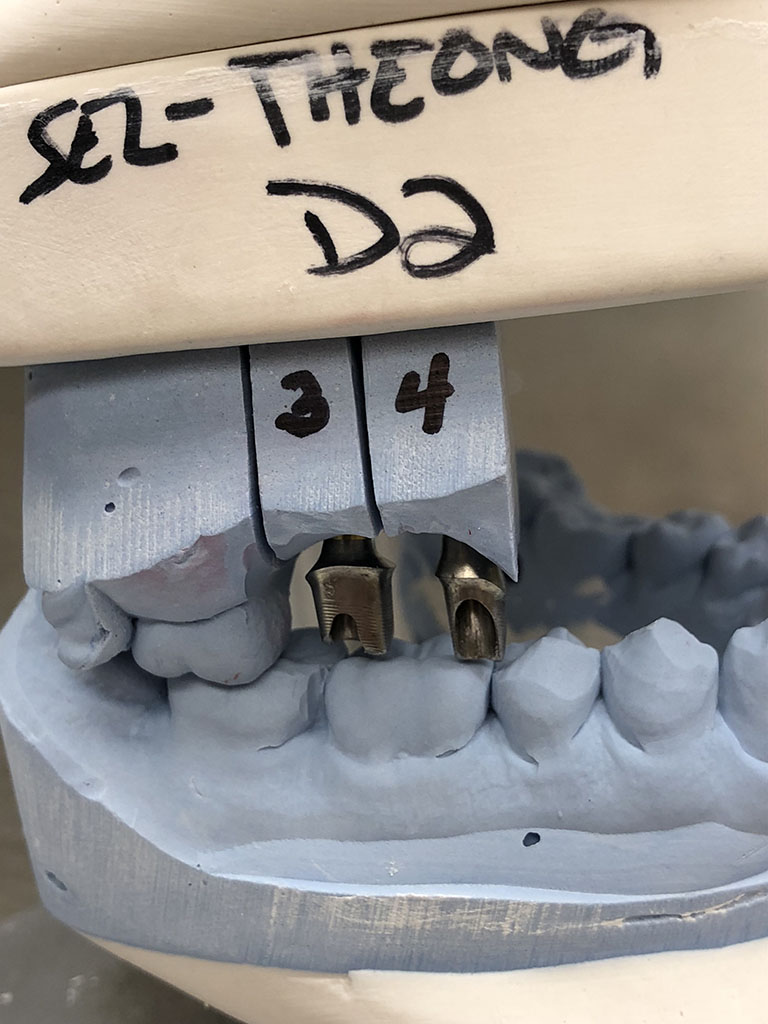 Distorted Impression - Brandon Dental Lab