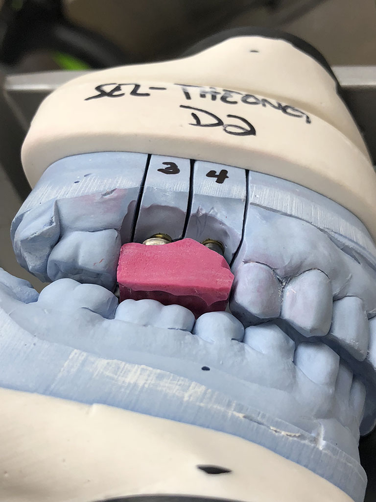 Distorted Impression - Brandon Dental Lab